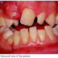 Dintii strambi la copii
